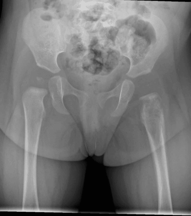 Pelvic radiograph showing an osteolytic lesion of the left proximal femoral metaphysis with cortical destruction and layered periosteal reaction