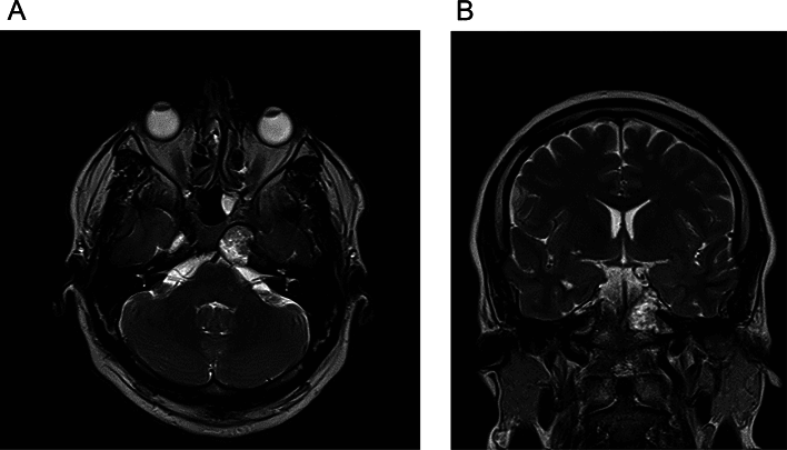 Axial and coronal MRI showing an LCH lesion involving the hypothalamic region and proximal pituitary stalk