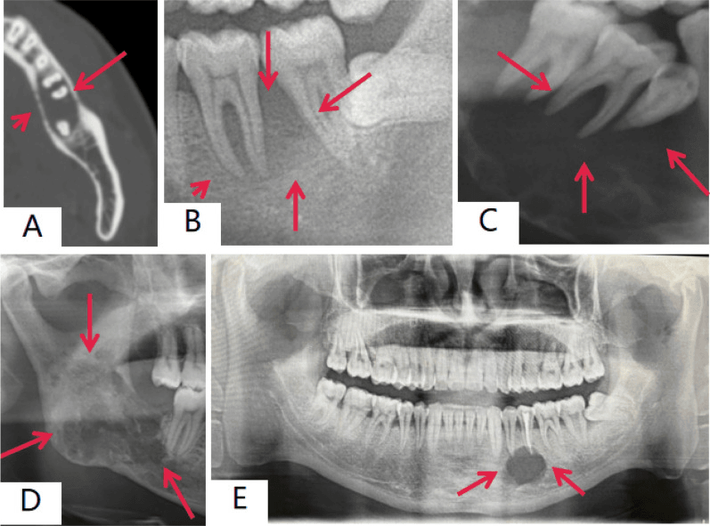 CT and dental radiographs showing alveolar floating-tooth osteomyelitis-like and cystoid patterns of jaw LCH