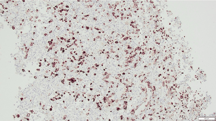 Langerin CD207 immunohistochemistry showing positive lesional cells in LCH