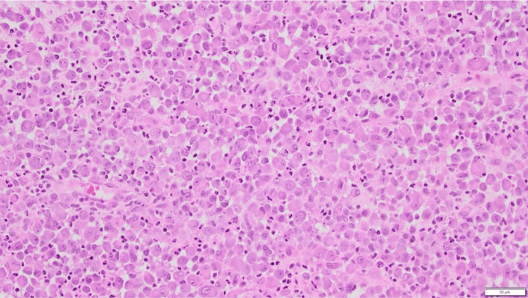 Haematoxylin and eosin micrograph showing Langerhans histiocytoid cells mixed with eosinophils