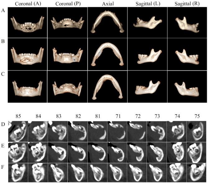 Serial multidirectional CT images demonstrating mandibular bone regeneration after treatment of LCH