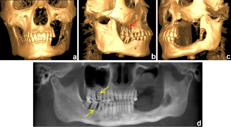 Three-dimensional maxillofacial CT reconstruction and panoramic dental image showing destructive jaw LCH and floating teeth