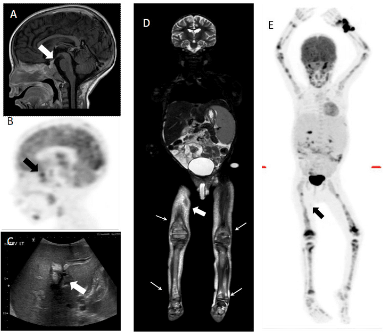 MRI ultrasound and FDG PET images demonstrating pituitary liver and skeletal involvement in multisystem paediatric LCH
