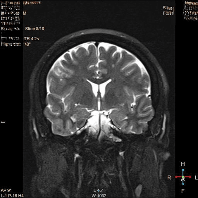 Postoperative coronal MRI showing resolution of a hypothalamic-pituitary LCH lesion
