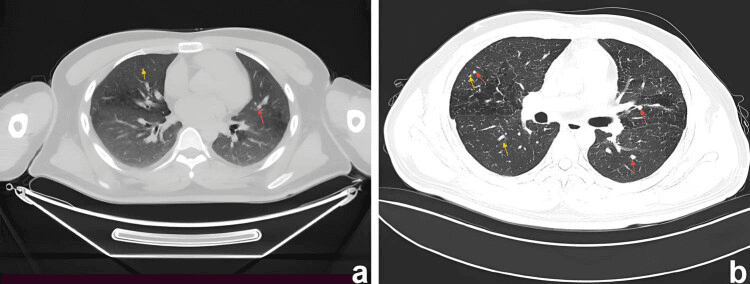 Axial chest CT images showing bilateral pulmonary nodules and cysts in Langerhans cell histiocytosis