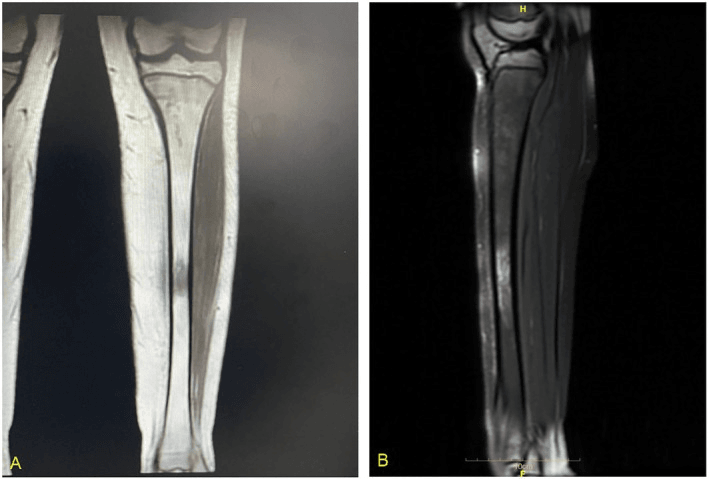 Coronal MRI of a tibial LCH lesion showing low T1 and high T2 marrow signal