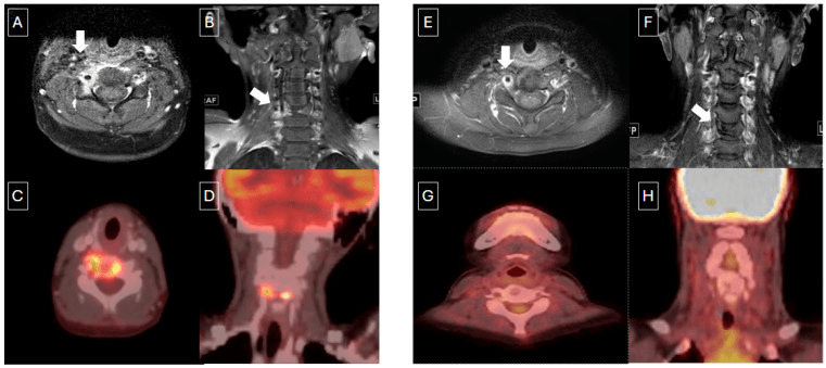 MRI and FDG PET CT of vertebra plana before and after treatment in multifocal bone LCH