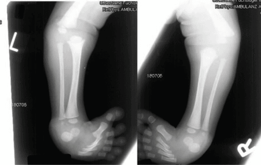 Lower-limb radiographs in Larsen syndrome showing bilateral clubfoot and anterior dislocation of the tibia on the femur