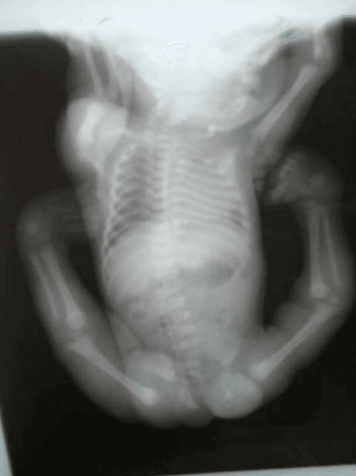 Whole-body babygram radiograph of an infant with Larsen syndrome in frog-leg position with abducted dislocated limbs
