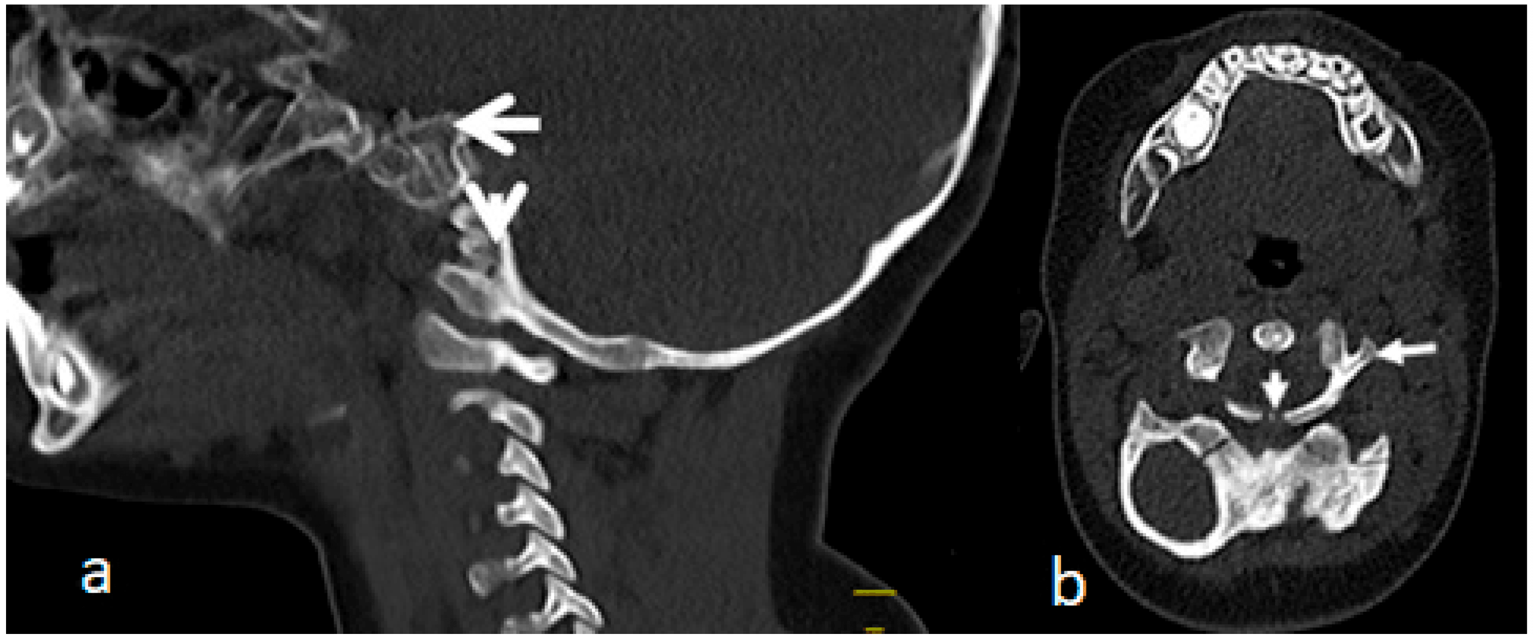 Sagittal and axial three-dimensional CT reconstructions showing congenital C1 malformation in severe Larsen syndrome