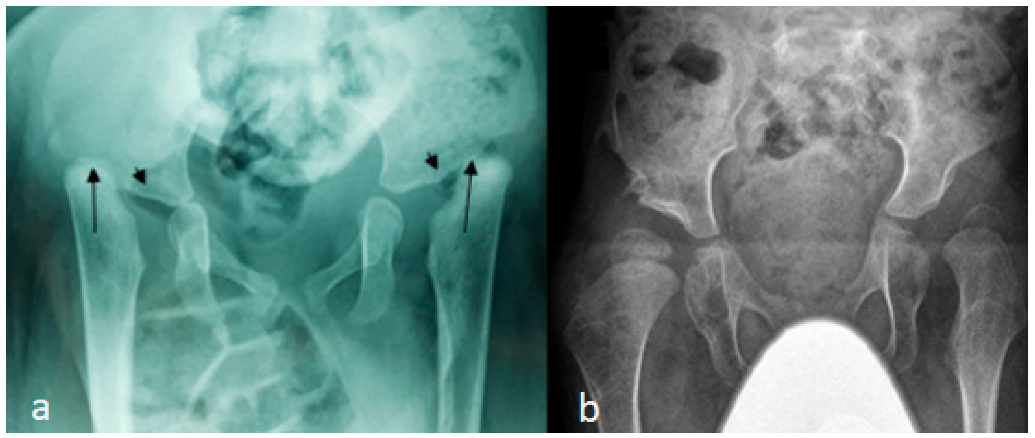 Paediatric AP pelvis radiographs showing bilateral congenital hip dislocation and severe acetabular dysplasia in Larsen syndrome