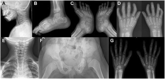 Multi-panel Larsen syndrome radiographs showing cervical subluxation, accessory calcaneal ossification and advanced carpal ossification