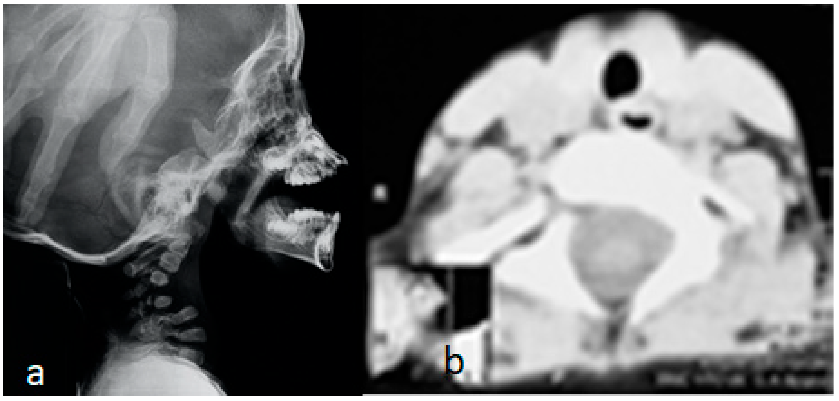 Lateral cervical radiograph and axial CT showing C1-C2 instability, kyphosis and C4 hypoplasia in Larsen syndrome