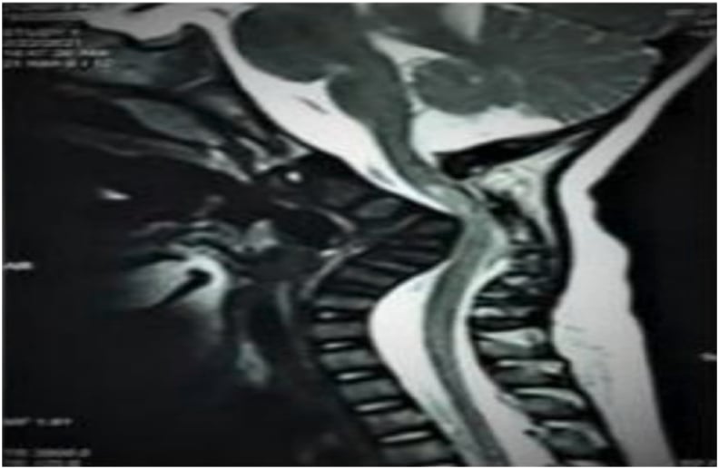 Sagittal T2 MRI showing severe cervical kyphosis, cord compression and myelomalacia in Larsen syndrome