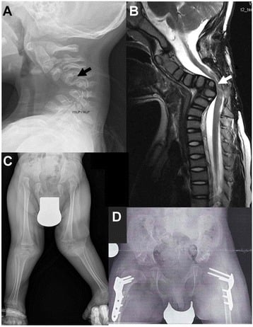 Larsen syndrome cervical radiograph and myelogram with hip and lower-limb survey