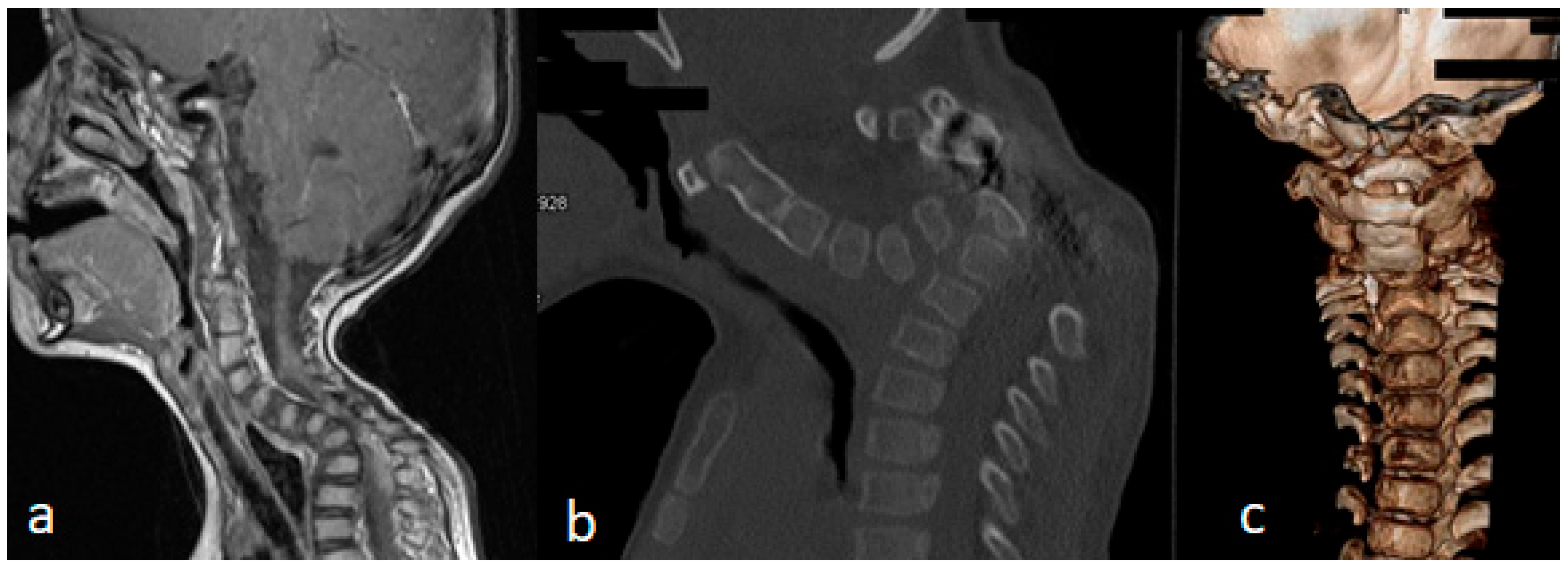 Sagittal MRI and three-dimensional CT showing severe cervicothoracic kyphosis and hypoplastic cervical elements in Larsen syndrome