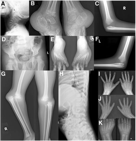 Multi-panel Larsen syndrome survey showing elbow and knee dislocations, double calcaneus and abnormal thumb phalanges