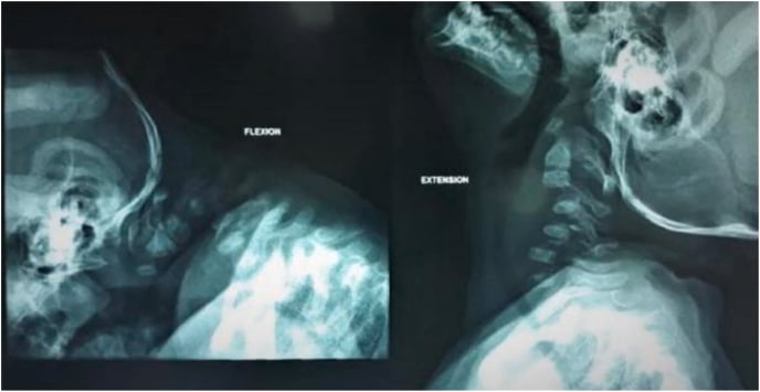 Flexion and extension cervical radiographs showing kyphosis, vertebral wedging and instability in Larsen syndrome