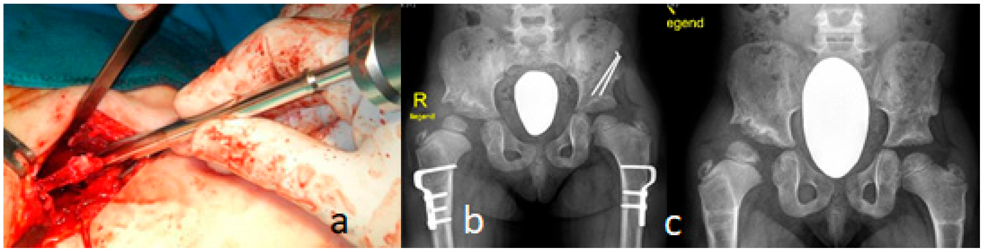Operative and radiographic panels showing hip reconstruction with femoral osteotomy in Larsen syndrome