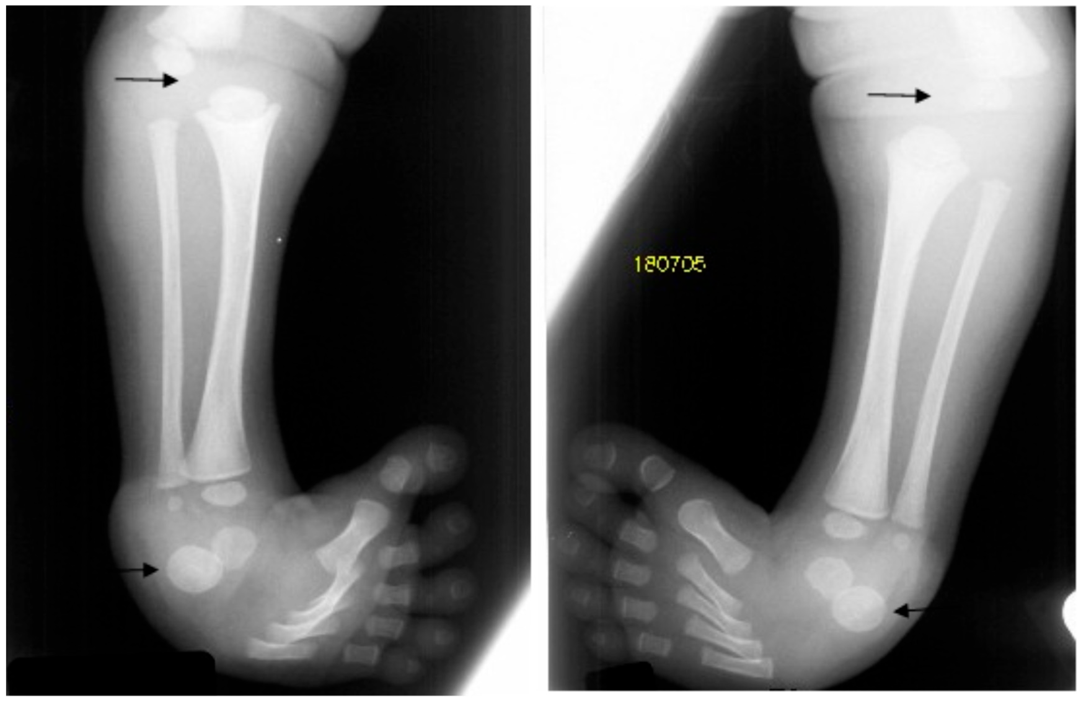 Bilateral lower-limb radiographs showing congenital knee dislocation, clubfeet and double calcaneal ossification in Larsen syndrome