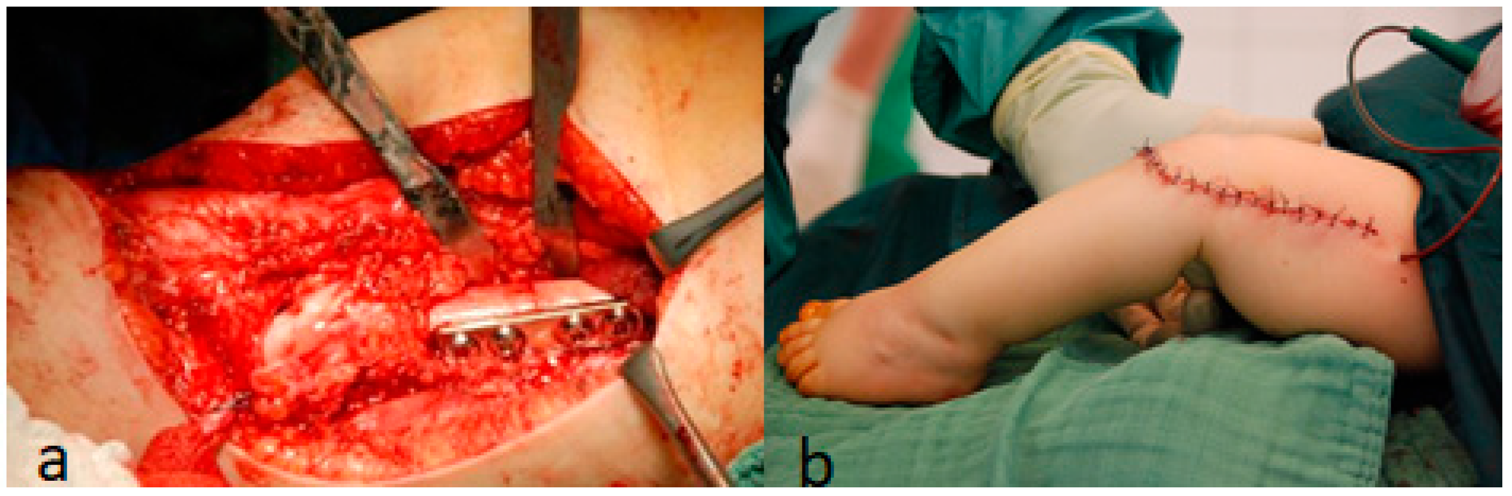 Operative panels showing V-Y quadricepsplasty and femoral shortening for congenital knee dislocation in Larsen syndrome