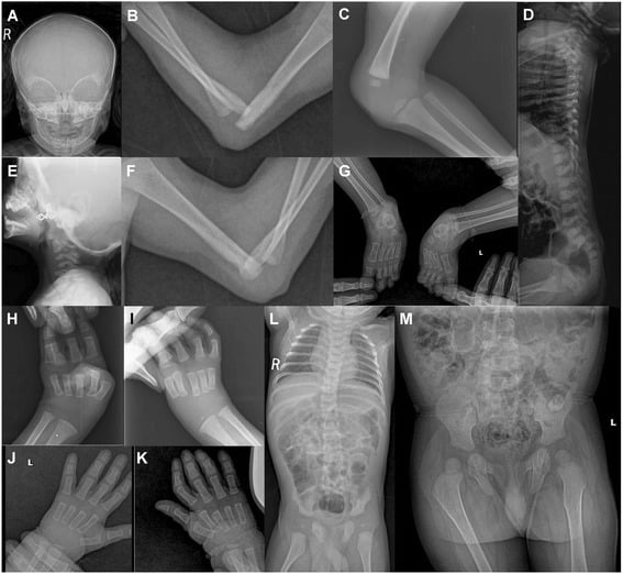 Multi-panel Larsen syndrome skeletal survey showing joint dislocations, cervical kyphosis and accessory ossification centres