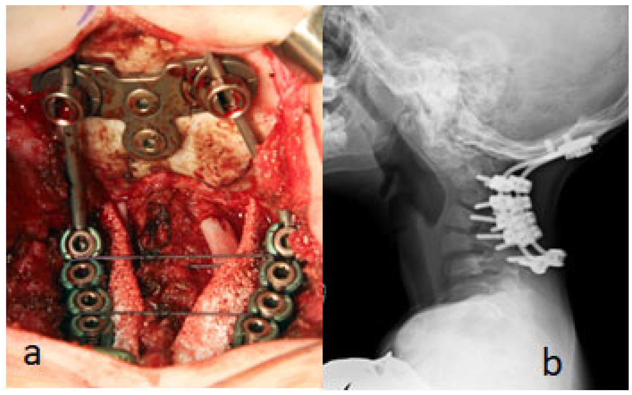 Operative and postoperative radiographic panels showing occipitocervical fixation in Larsen syndrome