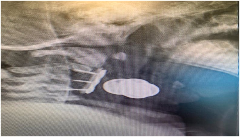 Postoperative lateral cervical radiograph showing anterior plate and strut graft after Larsen kyphosis correction