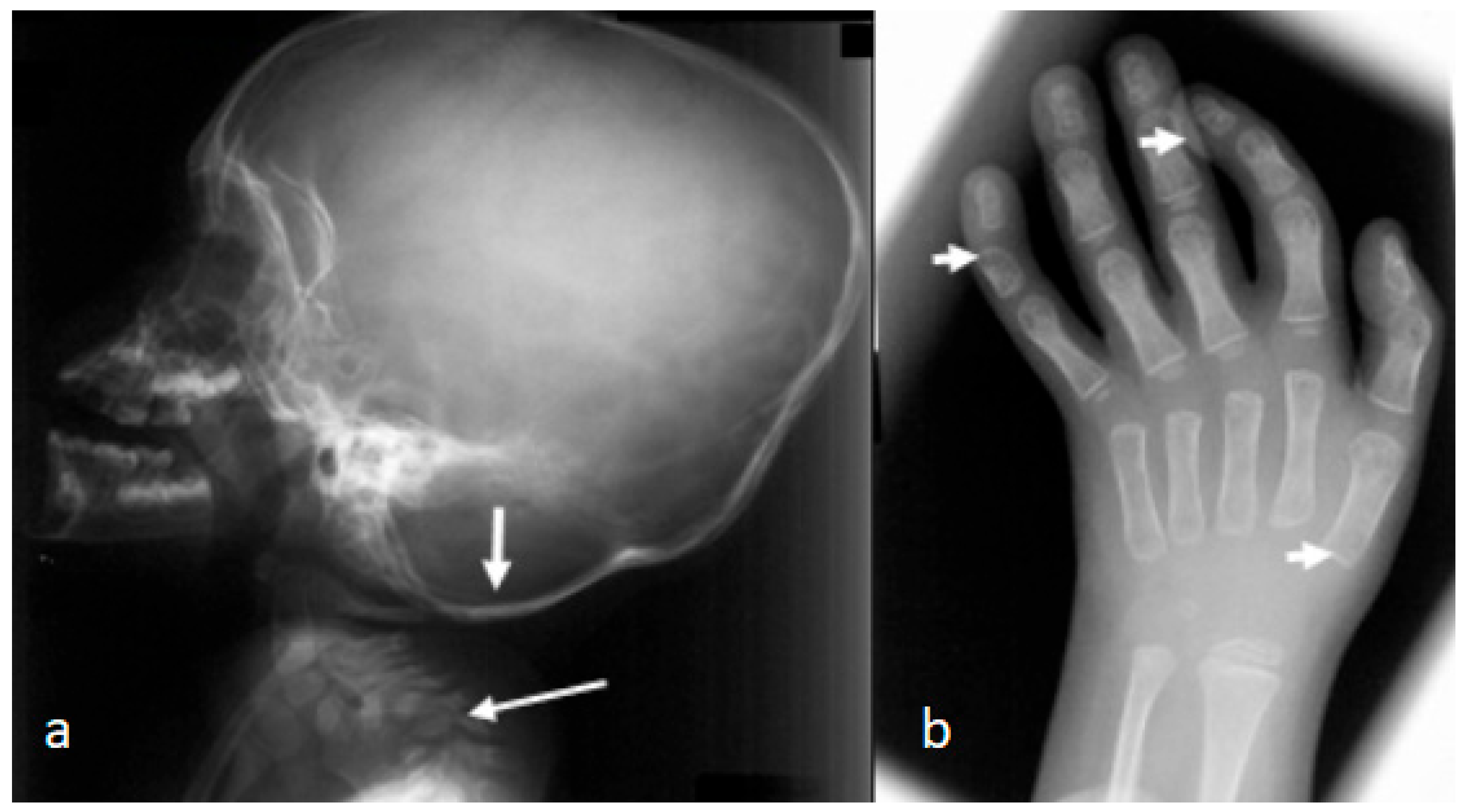 Lateral skull and hand radiographs in Larsen syndrome showing cervical kyphosis and accessory hand ossification