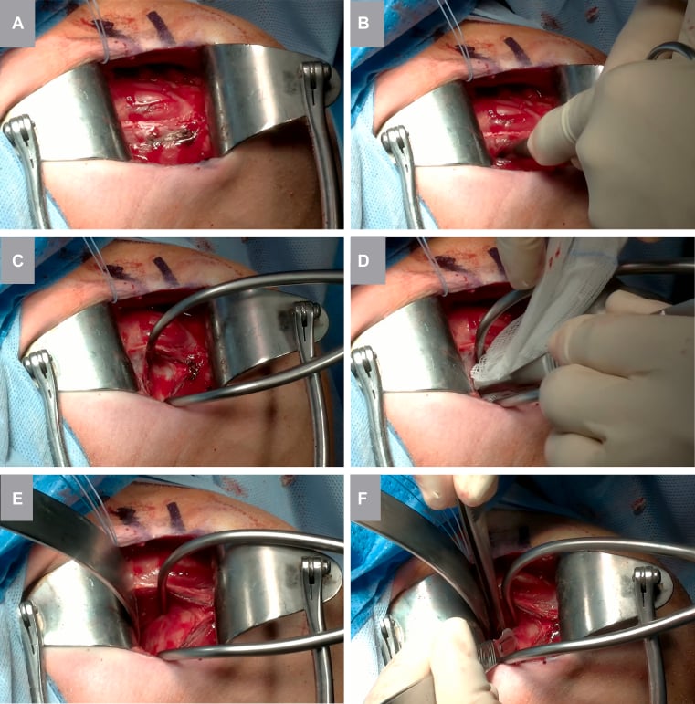 Sequential intraoperative photographs showing a muscle-splitting approach through subscapularis to the anterior capsule.