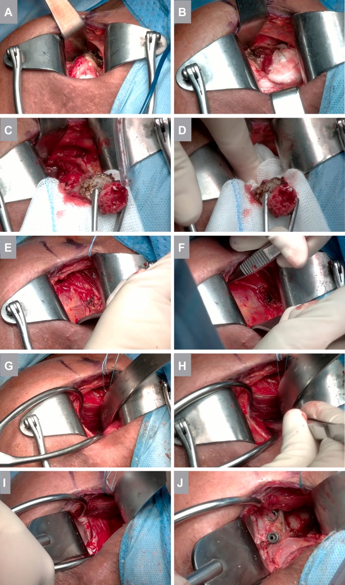 Ten-panel intraoperative sequence showing protection beneath the coracoid, osteotomy and graft preparation during open Latarjet.