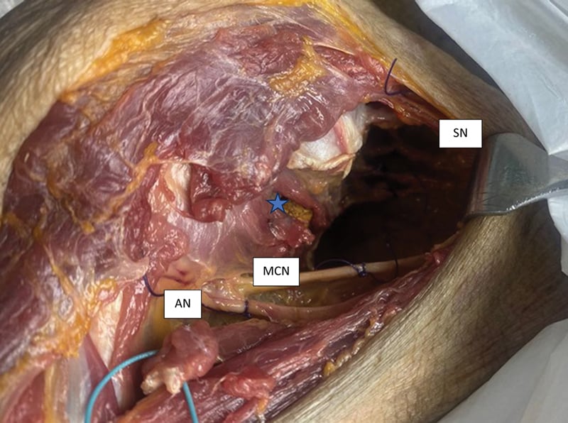 Cadaveric deltopectoral dissection showing the axillary, musculocutaneous and subscapular nerves around the subscapularis split and conjoint tendon.