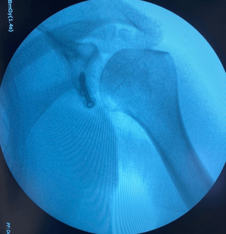 Intraoperative fluoroscopic image confirming two parallel screws fixing the coracoid graft to the anteroinferior glenoid.