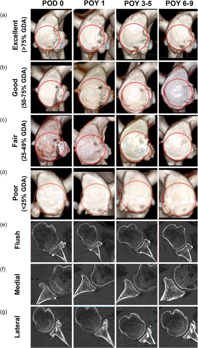 Serial three-dimensional and axial CT examples comparing excellent, good, fair and poor Latarjet graft positions and remodelling.