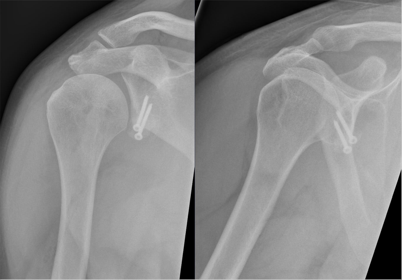 AP shoulder radiographs after a Latarjet procedure showing the transferred coracoid fixed to the anterior glenoid with two screws.