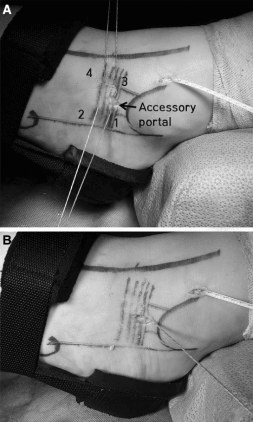 Two operative photographs of suture retrieval through a labelled accessory portal during arthroscopic Broström repair