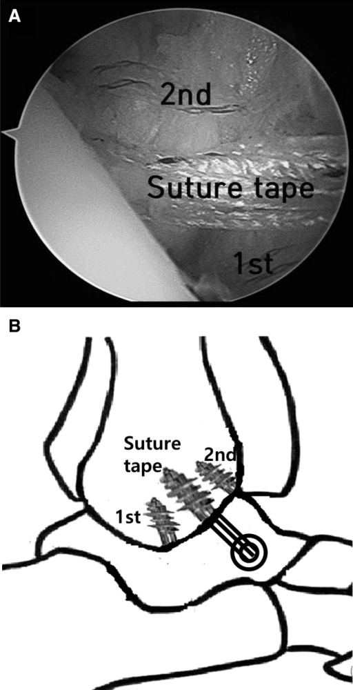 Arthroscopic view labelled with first and second anchor positions and suture tape, above a diagram of two fibular anchors with suture tape