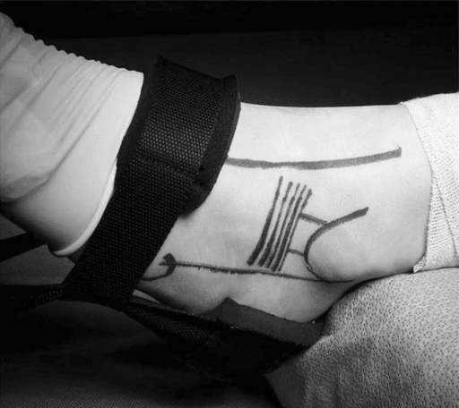 Skin markings of the surface landmarks on the ankle before an arthroscopic Broström repair, the ankle held in a strap