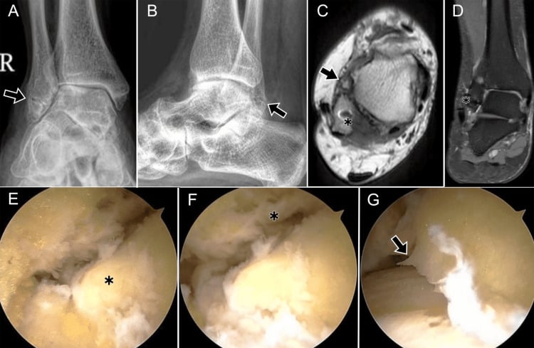 Radiographs, MRI and arthroscopic views of tibiotalar osteoarthritis in chronic lateral instability, with arrows and asterisks
