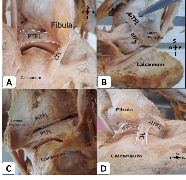 Cadaveric dissection showing lateral ankle ligament complex: ATFL, CFL, and PTFL