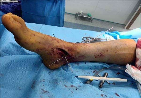 Intraoperative photograph of the leg with guide wires placed through the wound to plan tunnels for a multiligament reconstruction