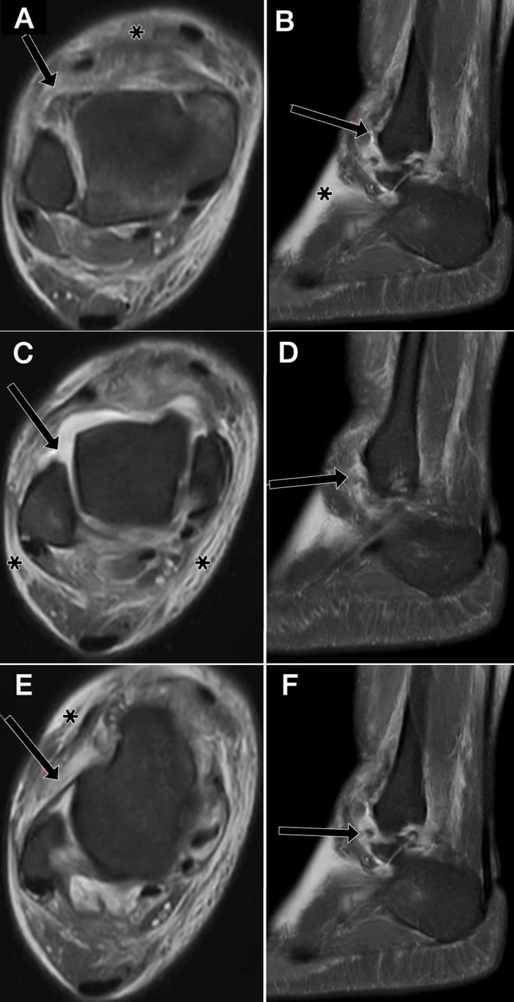 Paired axial and sagittal MRI with arrows marking combined anterior syndesmotic and ATFL tears after inversion injury