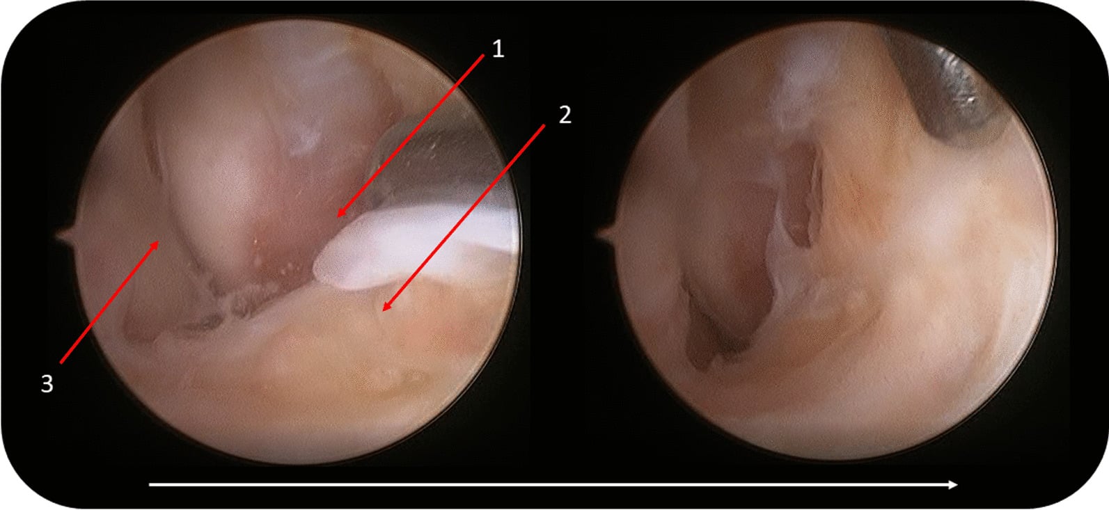Arthroscopic view of ATFL remnant separated from bone during arthroscopic ligament repair