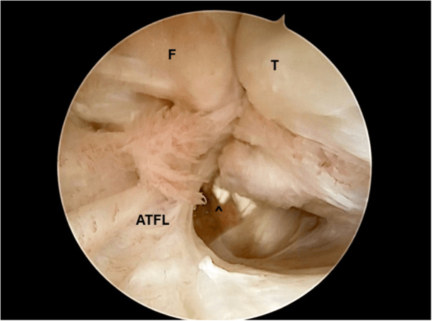 Arthroscopic view of a torn ATFL with the fibula, talus and ATFL labelled and a caret marking the gap beneath the frayed fibres