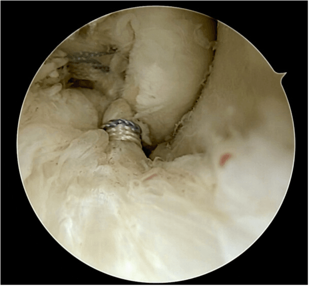 Arthroscopic view of the final two-bundle ATFL repair with suture passage