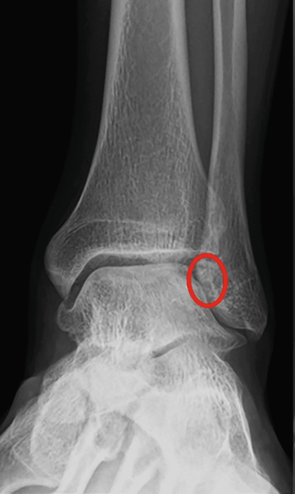 Preoperative frontal ankle radiograph with a red circle at the lateral margin of the joint between talar dome and plafond