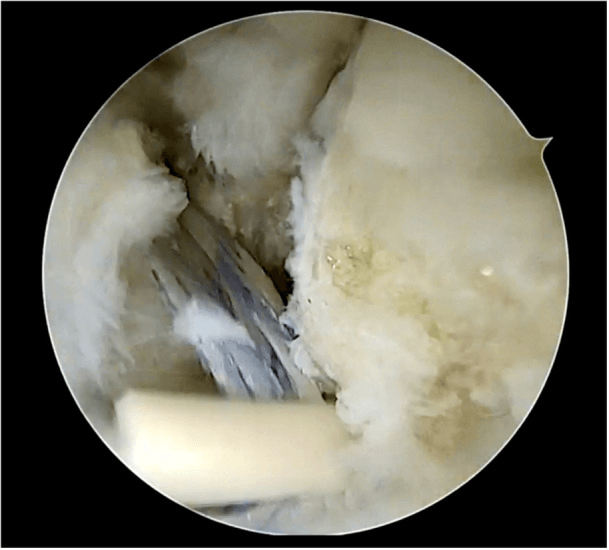 Arthroscopic view of a completed ATFL repair with striped suture tape alongside the repaired ligament