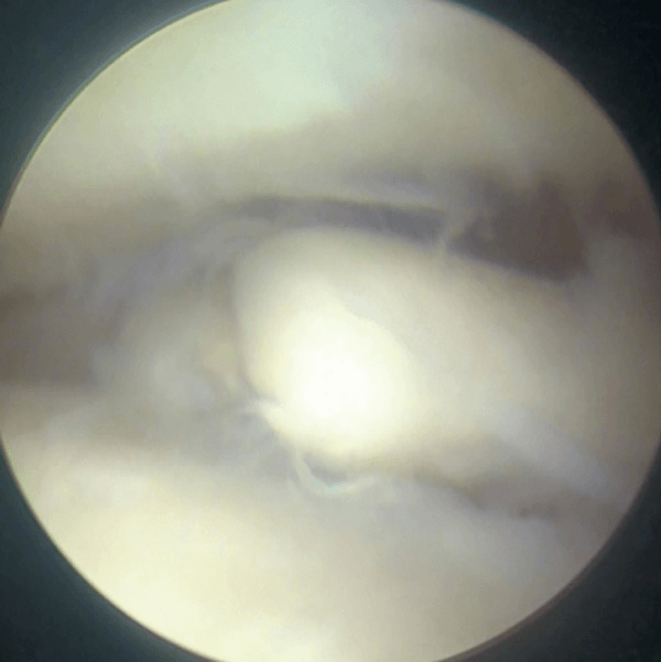 Arthroscopic view of an anterolateral talar osteochondral lesion