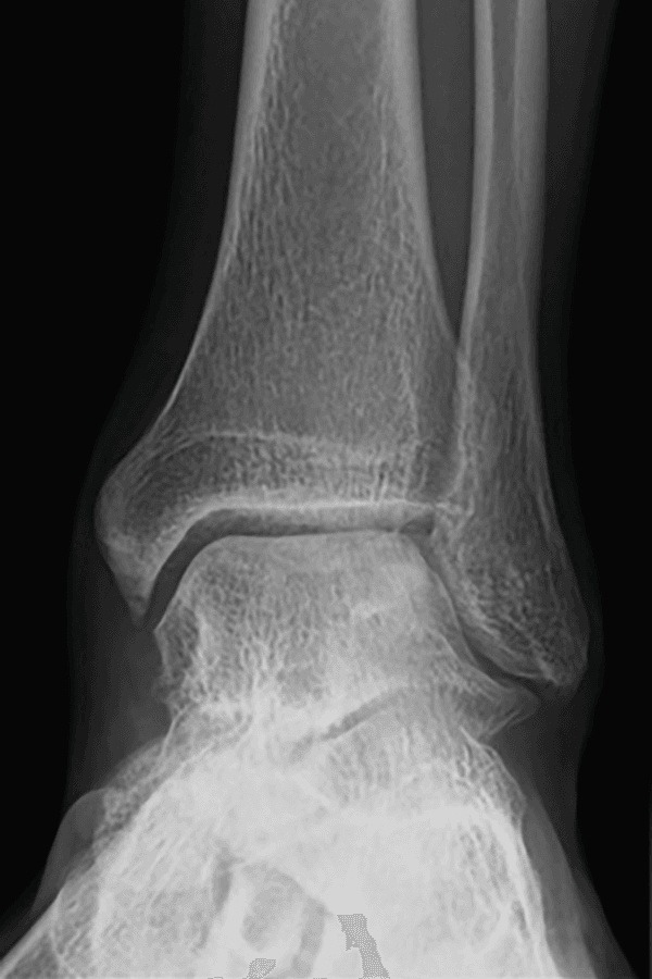 Postoperative frontal ankle radiograph showing union of a lateral talar-dome osteochondral graft